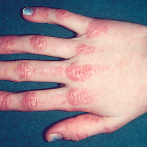 Idiopathic Inflammatory Myositis