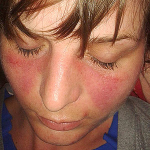 Systemic Lupus Erythematosus