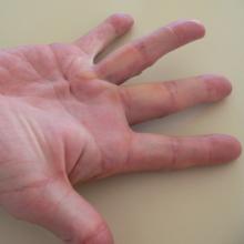 Dupuytren's contracture hand deformity 